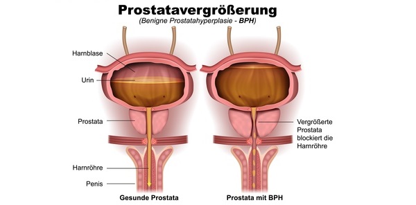 hausmittel prostata hund)