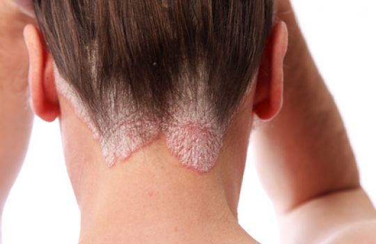 Intimbereich schuppenflechte Psoriasis im