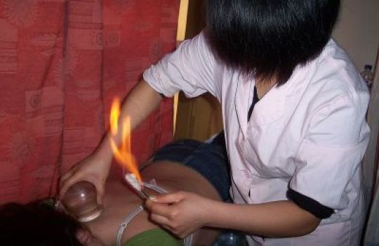 Eine Flamme wird über den Schröpfkopf gehalten, um einen Unterdruck zu erzeugen.