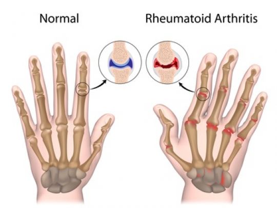 Schematische Darstellung einer normalen und einer rheumatoiden Hand
