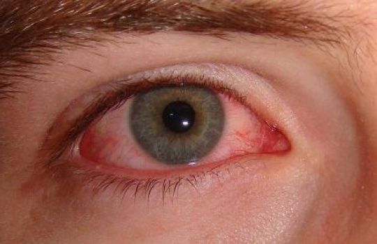 Die Rötung des Auges ist das häufigste Symptom bei einer Bindehautentzündung.