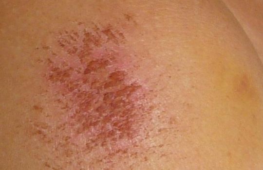 Offene Stellen an der Haut heilen sich zwar selbst, dennoch sollte man Infektionen vermeiden.
