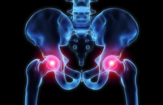 Durch Rheuma ausgelöste Schmerzen im Hüftgelenk ist die Beweglichkeit der Patienten eingeschränkt.