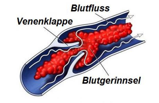 Verstopfen Blutgerinnsel die Venenklappen kann dies gefährlich werden.