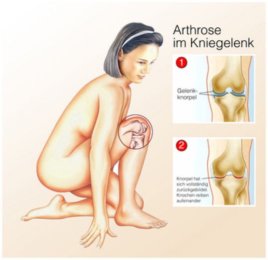 Illustration von Arthrose im Knie, oben gesunder Gelenkknorpel, unten Knorpel hat sich zurückgebildet.