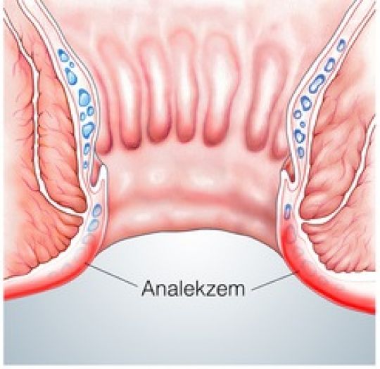 Entzündete Haut im Analbereich, blau dargestellt sind die Hämorrhoidalpolster.