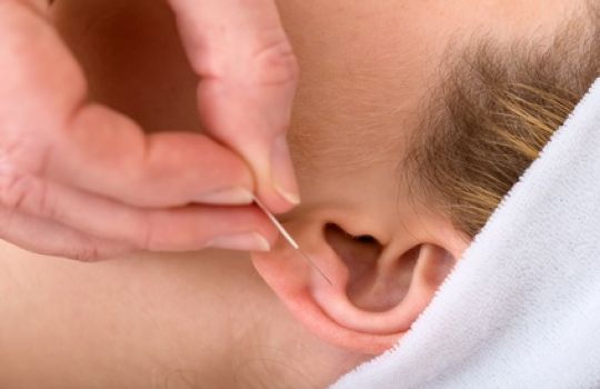 Frau erhält als Behandlung eine Ohr-Akupunktur mit Nadeln.