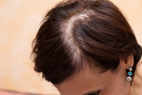 Haarausfall Ursachen Naturliche Mittel Bei Mann Frau Phytodoc