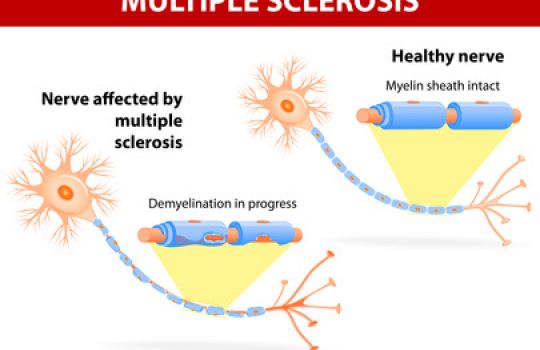 Bei Multipler Sklerose greift der Körper die Nervenzellfortsätze an.