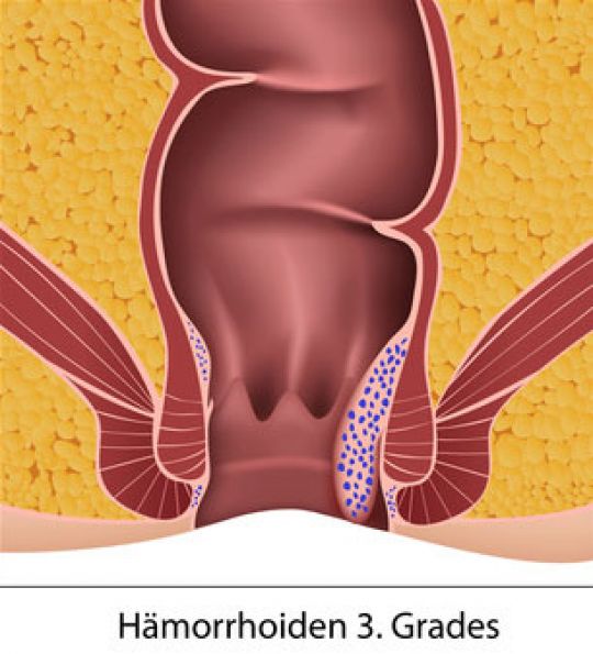 Symptome Und Schweregrade Bei Hämorrhoiden Phytodoc 