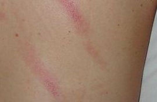 Strichförmige Hautreizungen überziehen den Rücken des Patienten.